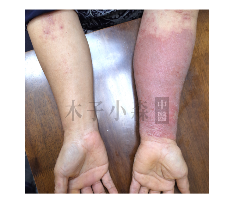 接觸性皮膚炎是一種常見的皮膚疾病，當患者接觸到特定物質而引起皮膚發炎，都能將之稱為接觸性皮膚炎。接觸性皮膚炎可分成兩種類型：第一種是刺激性的皮膚炎，是由於慢性或急性刺激造成，例如長時間使用清潔劑、染劑或化學藥物等，第二種則是過敏性皮膚炎，由於患者的體質接觸過敏原而引發皮膚炎。